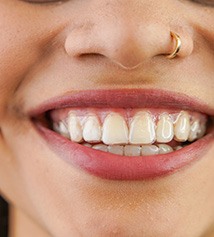 Closeup of woman smiling with clear aligners