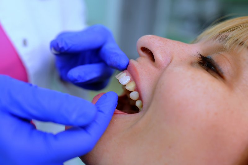 A dentist placing veneers on a patient’s teeth